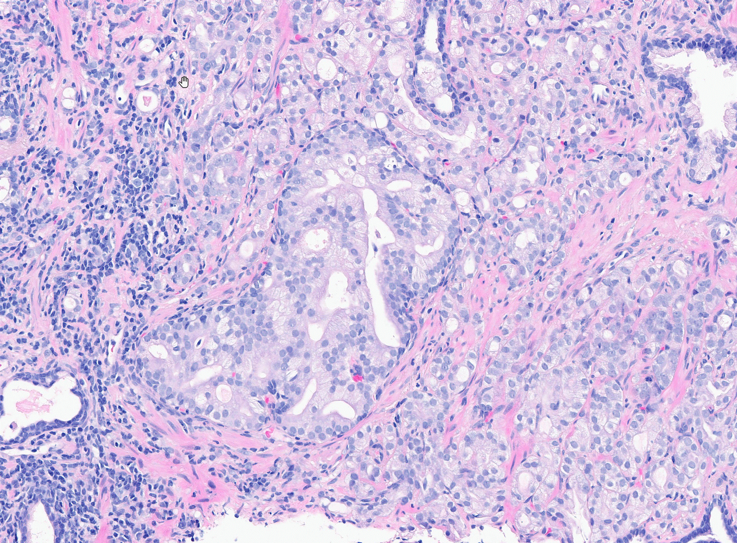 Simon Bott is the first in the UK to use AI assistance for Prostate Biopsy Results